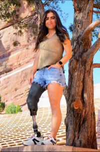 Angelina Martinson with prosthetic